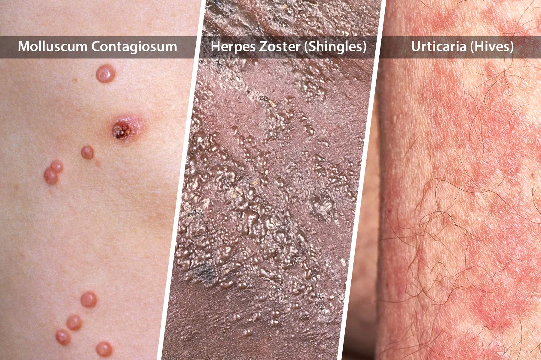 Skin Lesions Aids