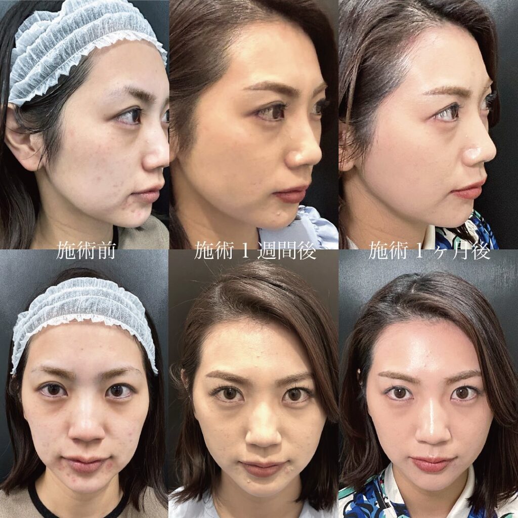 糸リフトのダウンタイム完全解剖！腫れピークと仕事復帰の真相2026