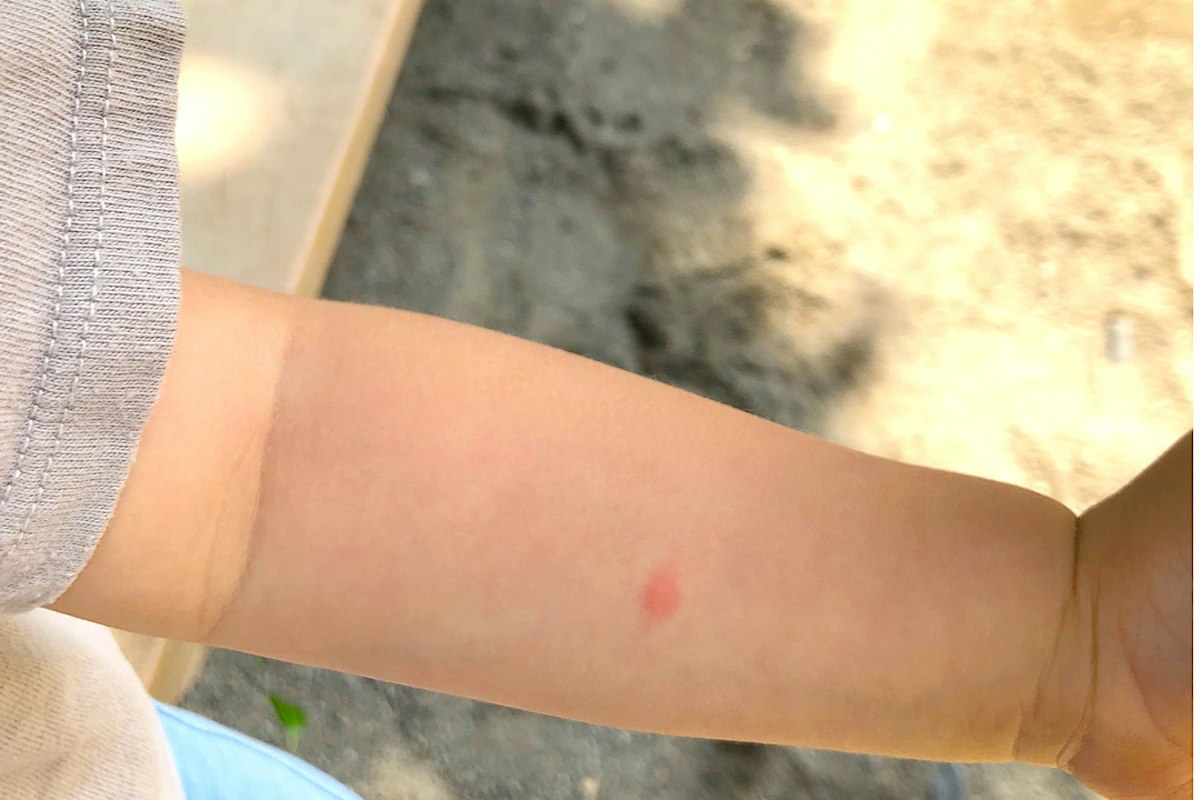 子供の虫刺されがパンパンに腫れる原因と受診目安｜2026年最新対処法