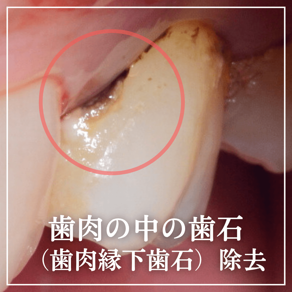 歯茎の奥に潜む黒い毒素！縁下歯石の恐怖と正しい除去法を徹底解説