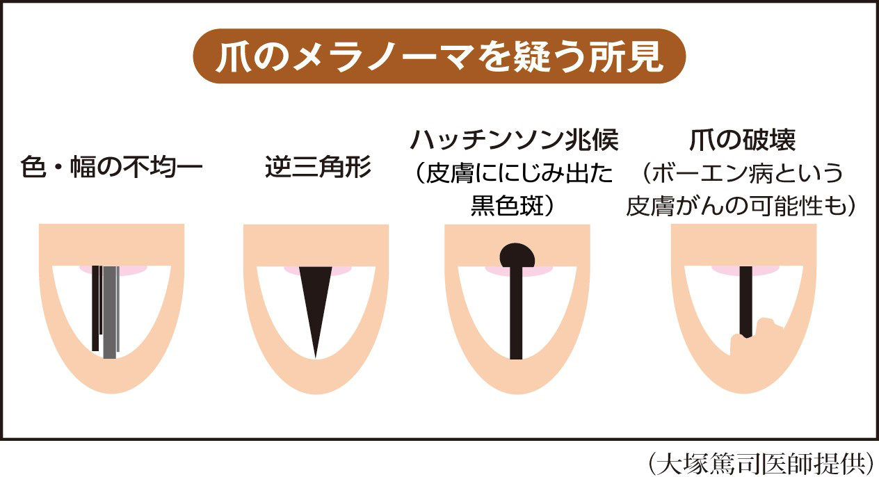 爪の黒い線は病気のサイン？メラノーマの見分け方と危険度チェック