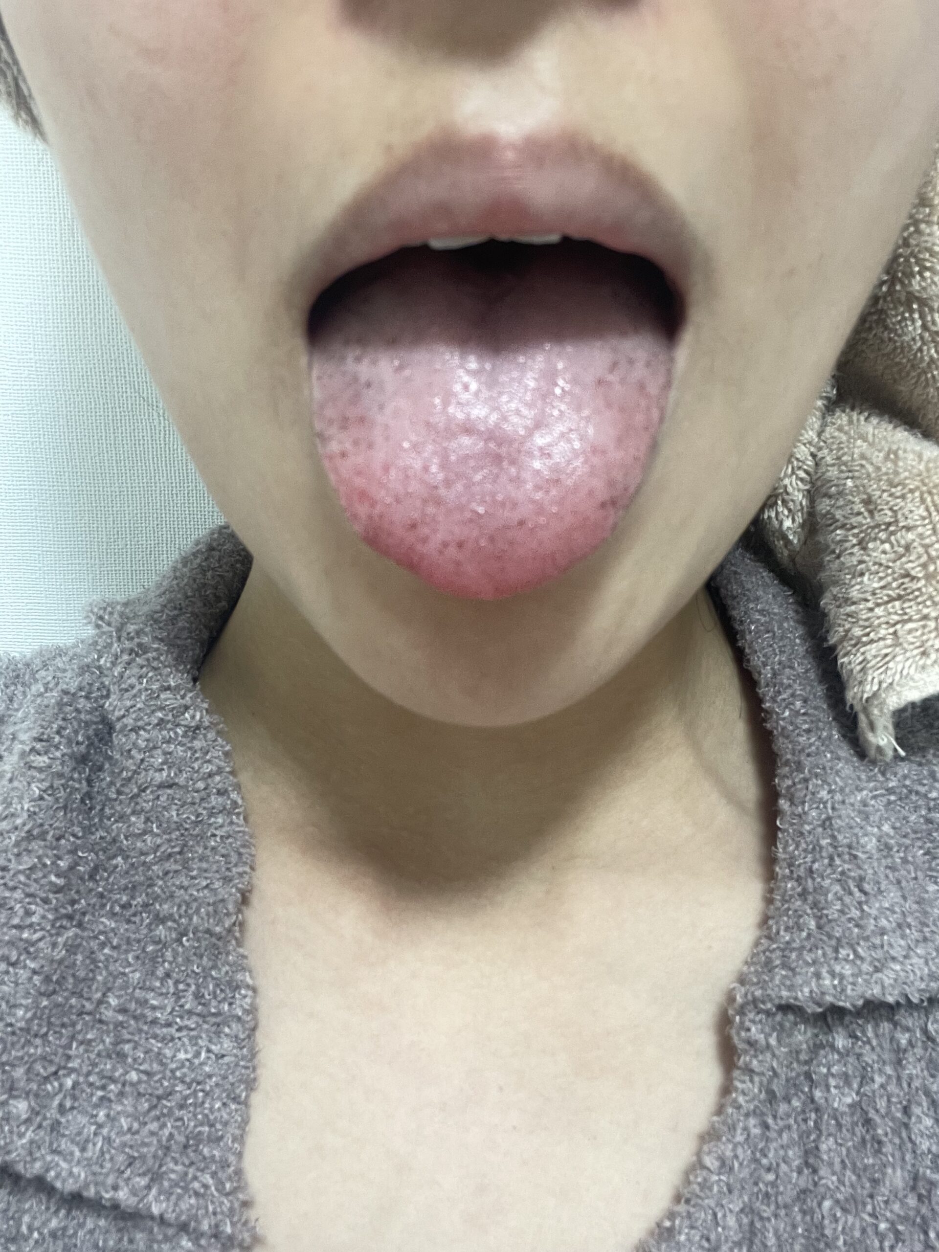 舌に黒い点は血豆か癌か？見分け方と受診科の判断基準を徹底解説