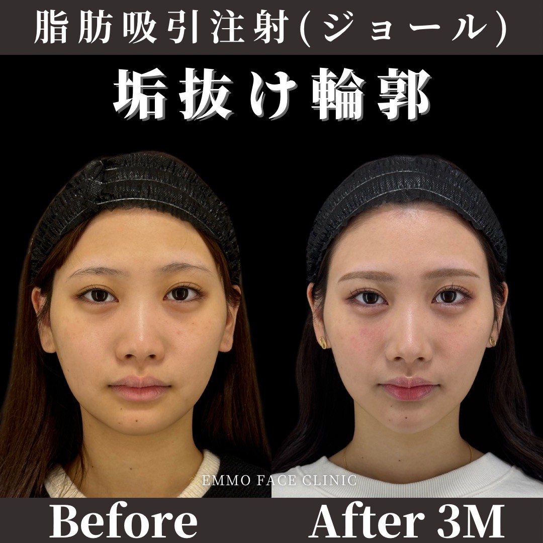 運動で痩せない頬肉の落とし方とは？2026年最新の顔痩せ術を徹底検証