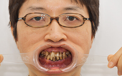 【徹底調査】 歯 が ボロボロ 芸能人 ファン必見の最新情報 #969