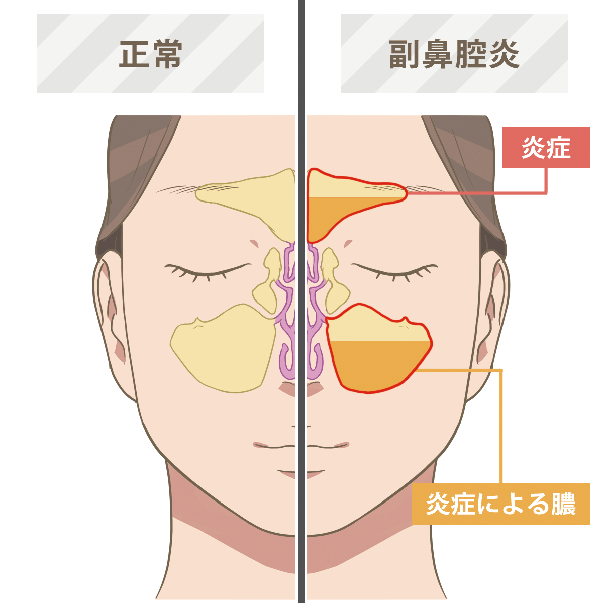 鼻水が黄緑色になるのはなぜ？放置厳禁な蓄膿症のサインと受診目安を徹底解説