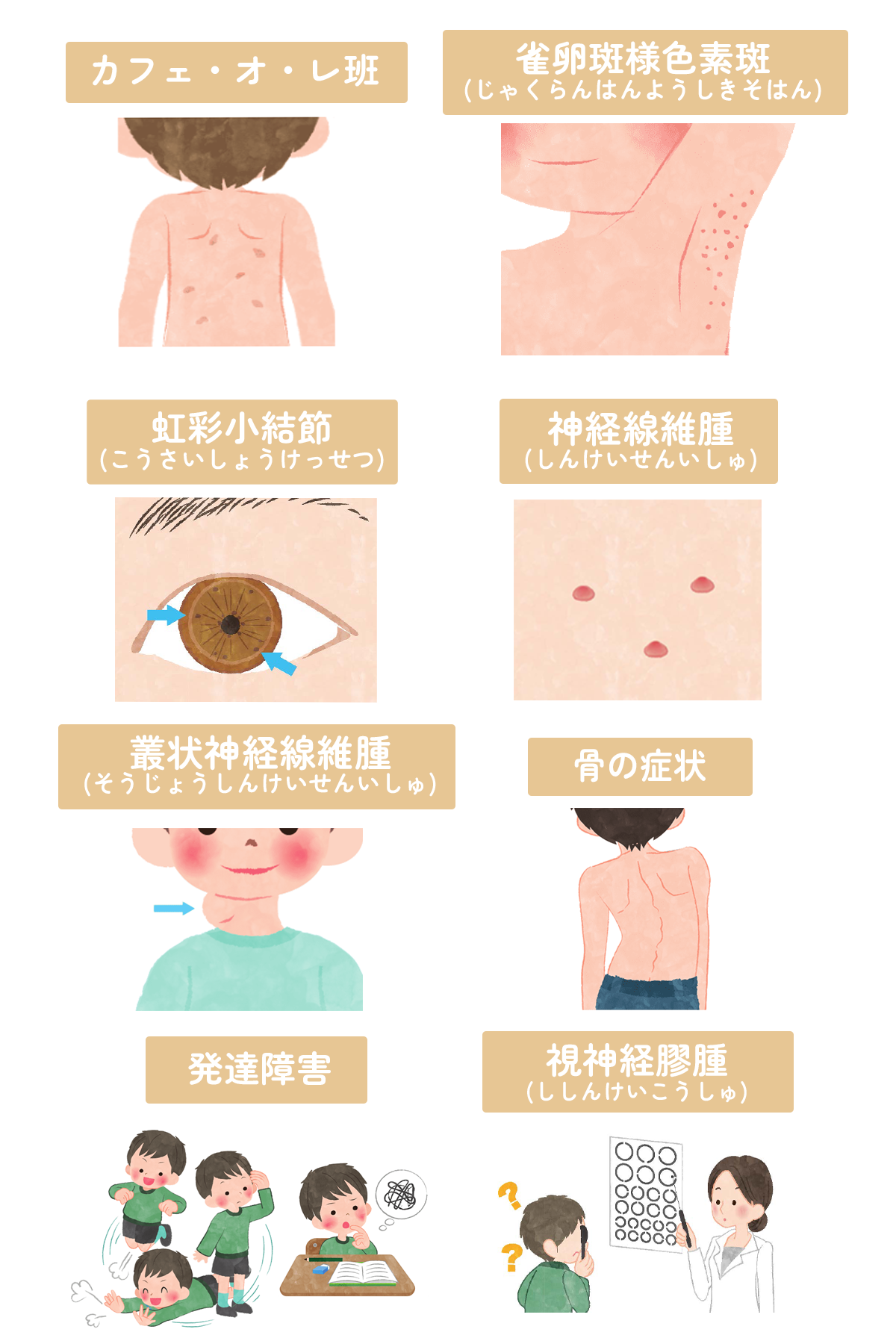 レックリングハウゼン病の初期症状と寿命｜最新治療と難病指定を徹底解説