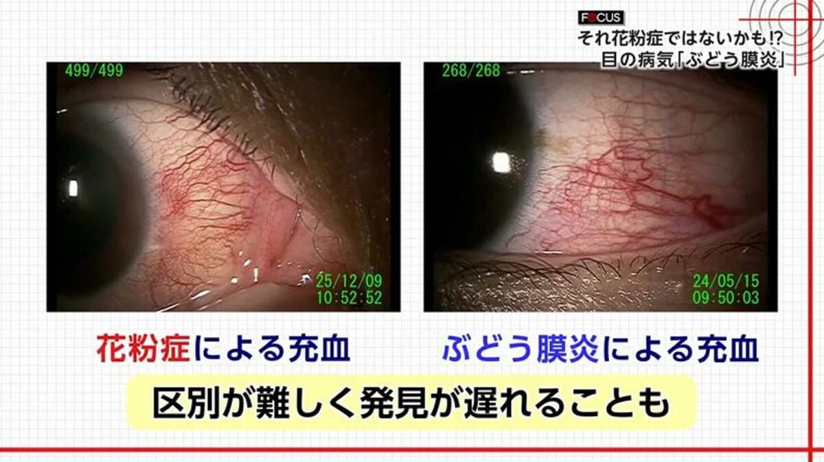 花粉症で目が真っ赤？充血が治らない理由と2026年最新の対処法