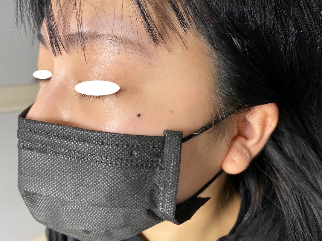 ダーマルピアスの真実！痛みや排除の確率と失敗を防ぐ全知識