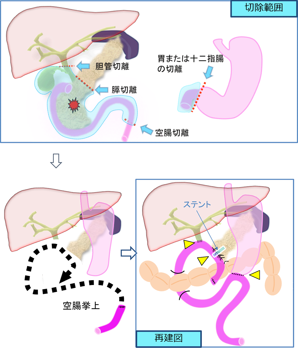 膵頭十二指腸切除術の真実｜後遺症の真相と生存率・後悔なき選択基準