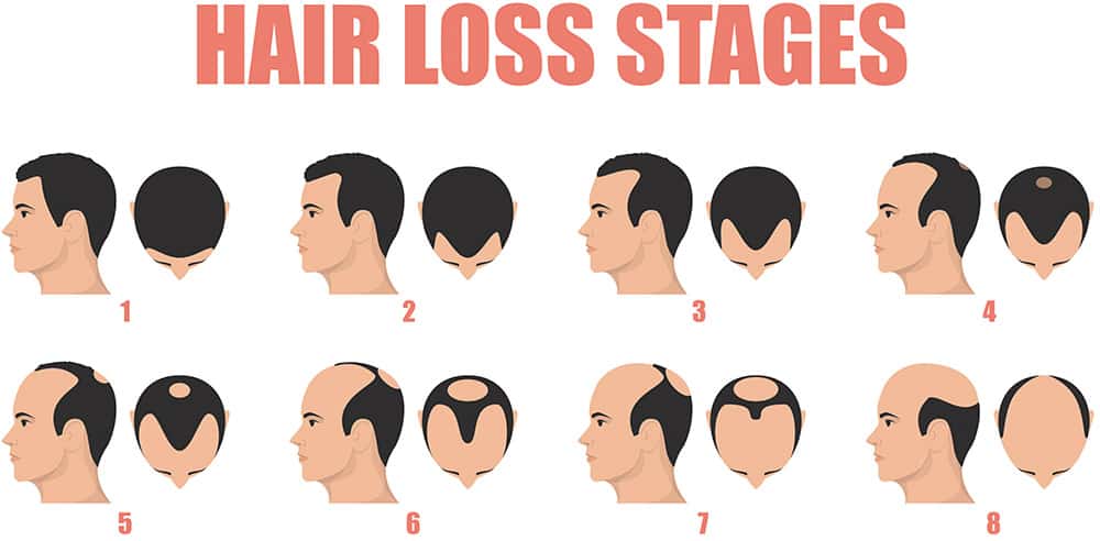 When Does Balding Start in Men