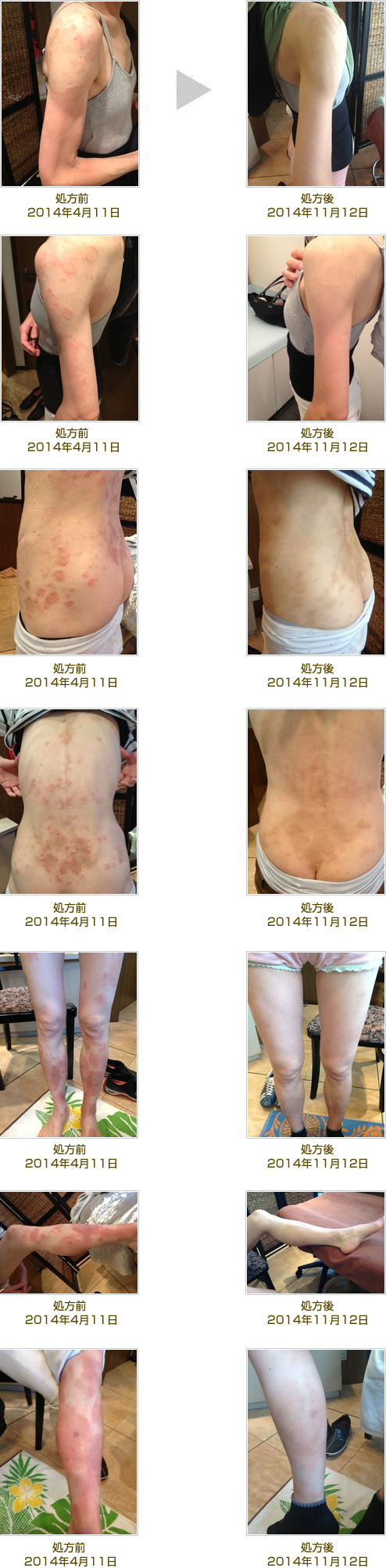 汗をかくと針で刺すような激痛？コリン性蕁麻疹の原因と治し方徹底解説